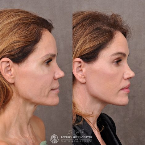 AuraLyft & Lip Lift with corner release - Right Side