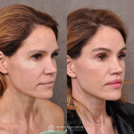 AuraLyft & Lip Lift with corner release - Right Side