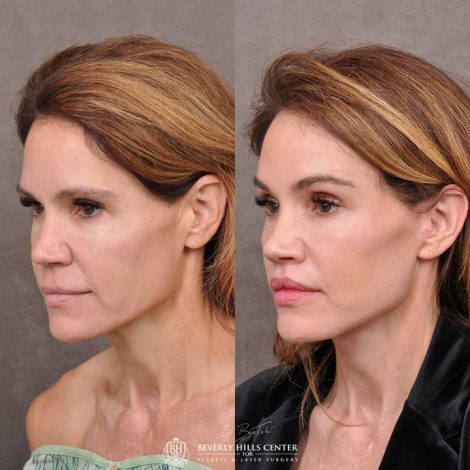 AuraLyft & Lip Lift with corner release - Left Side