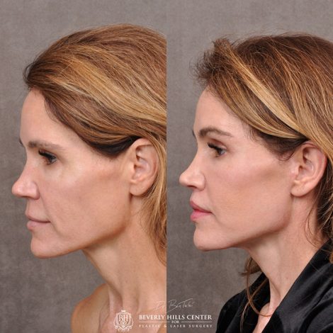 AuraLyft & Lip Lift with corner release - Left Side