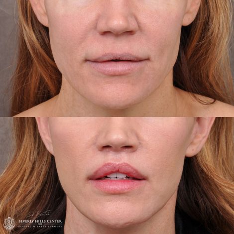 AuraLyft & Lip Lift with corner release - Front