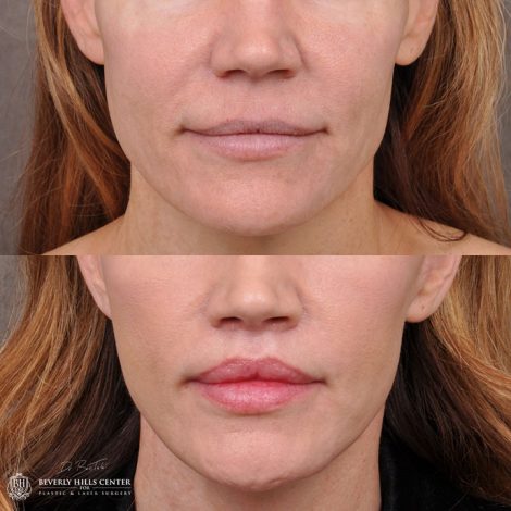 AuraLyft & Lip Lift with corner release - Front