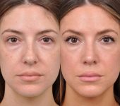 Beverly Hills Center Female Patient Before and After Rhinoplasty Procedure