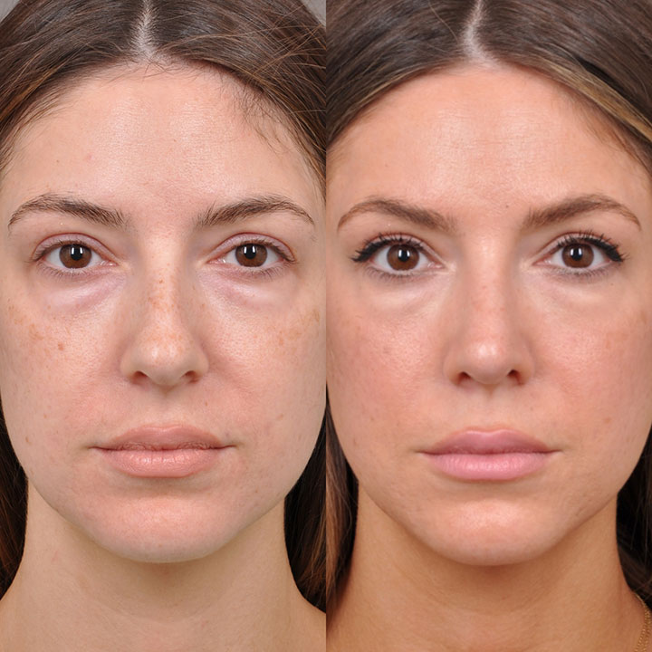 Causes of Hyperpigmentation Under the Eyes