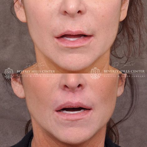 Modified Upper Lip Lift - Front