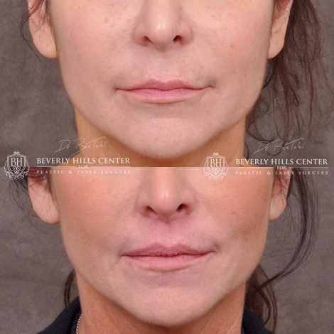 Modified Upper Lip Lift - Front