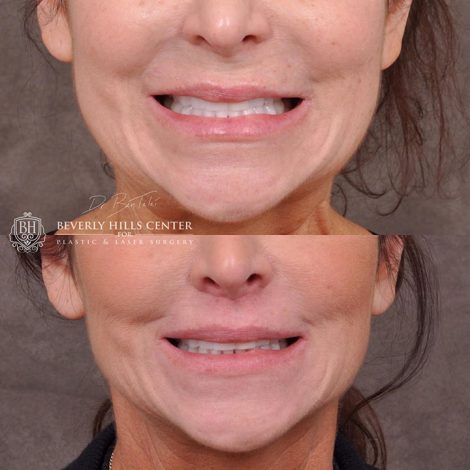 Modified Upper Lip Lift - Front