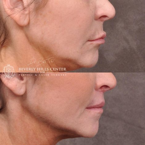 Modified Upper Lip Lift - Right Side