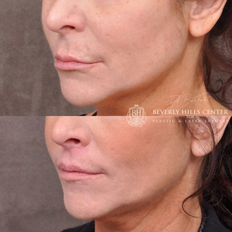 Modified Upper Lip Lift - Left Side