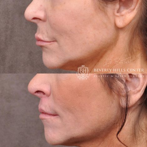 Modified Upper Lip Lift - Left Side