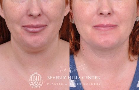 Mini Weekend Necklift (Profound RF with MicroLiposuction of the neck) - Front