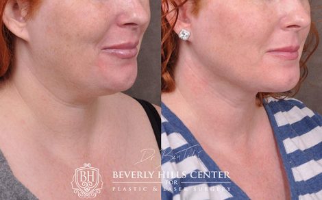 Mini Weekend Necklift (Profound RF with MicroLiposuction of the neck) - Right Side