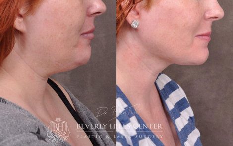 Mini Weekend Necklift (Profound RF with MicroLiposuction of the neck) - Right Side