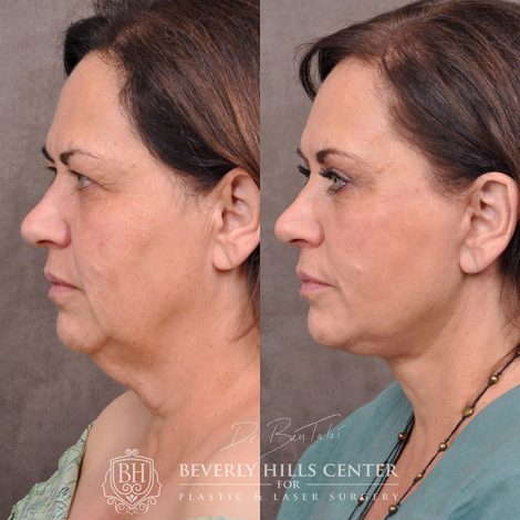 AuraLyft with Eyelid Rejuvenation - Left Side