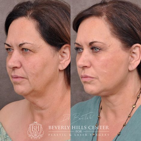 AuraLyft with Eyelid Rejuvenation - Left Side