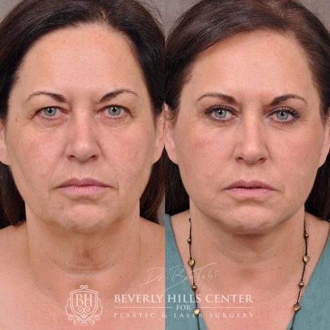 AuraLyft with Eyelid Rejuvenation - Front