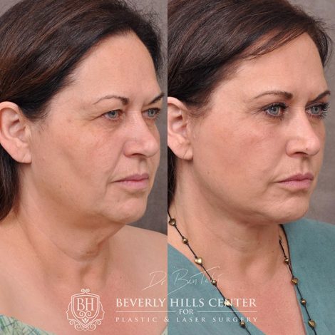 AuraLyft with Eyelid Rejuvenation - Right Side