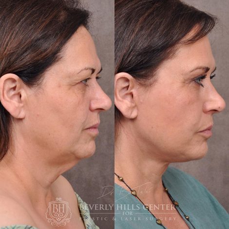 AuraLyft with Eyelid Rejuvenation - Right Side