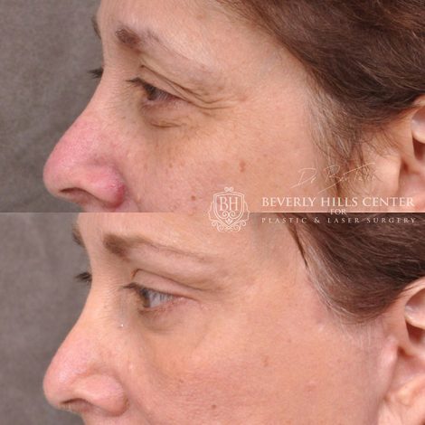 Eyelid Restoration - Left Side