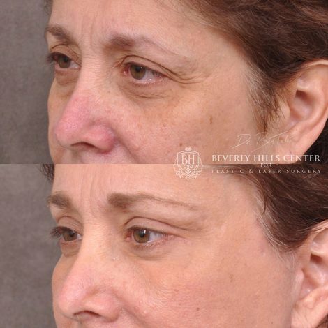 Eyelid Restoration - Left Side