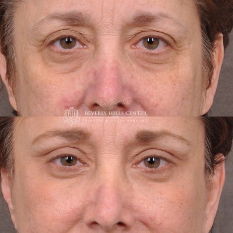 Eyelid Restoration - Front