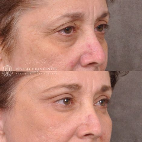 Eyelid Restoration - Right Side