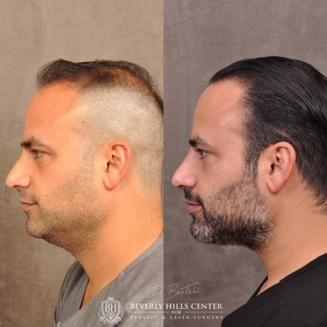 Beverly Hills Center Male Patient Before and After Profound RF and FUE Hair Transplant