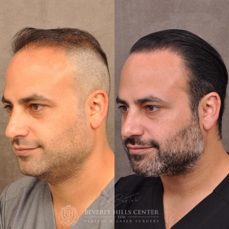 Beverly Hills Center Male Patient Before and After Profound RF and FUE Hair Transplant