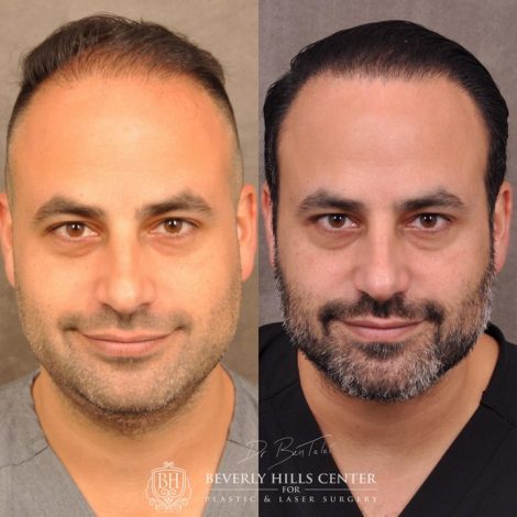 Beverly Hills Center Male Patient Before and After Profound RF and FUE Hair Transplant