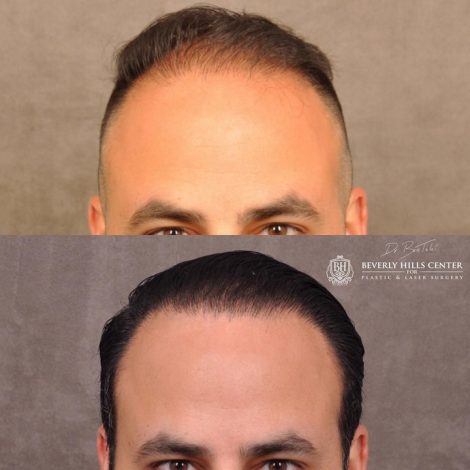 Beverly Hills Center Male Patient Before and After Profound RF and FUE Hair Transplant