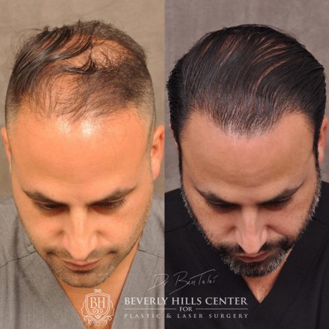 Beverly Hills Center Male Patient Before and After Profound RF and FUE Hair Transplant