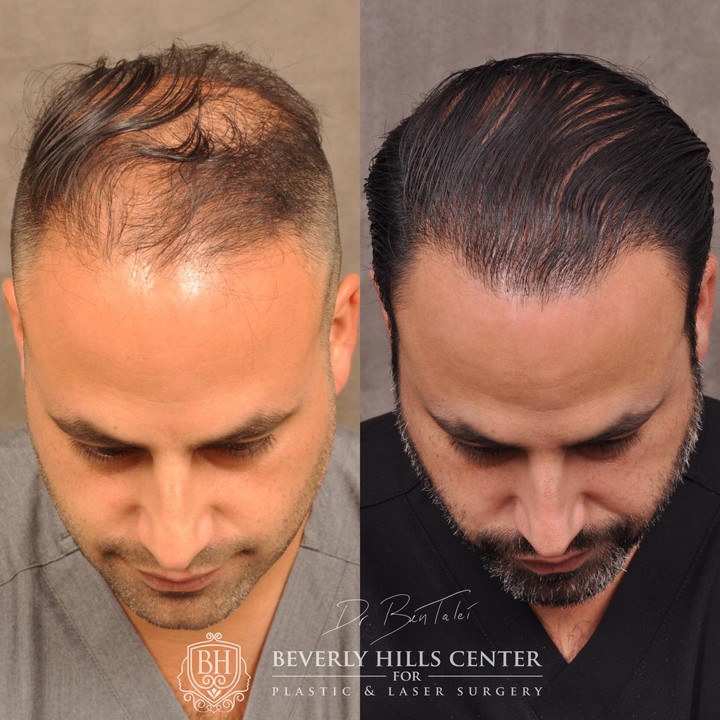 Hair Transplant & Hairline Lowering – Before & Afters - Beverly Hills Center