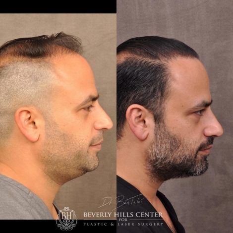 Beverly Hills Center Male Patient Before and After Profound RF and FUE Hair Transplant