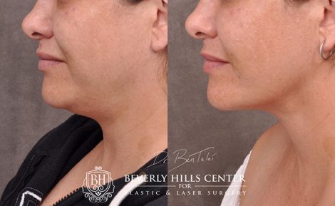 Mini Weekend Neck Lift - Left Side