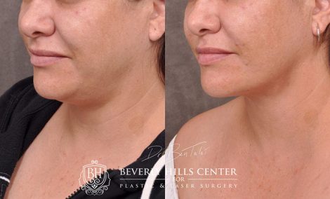 Mini Weekend Neck Lift - Left Side