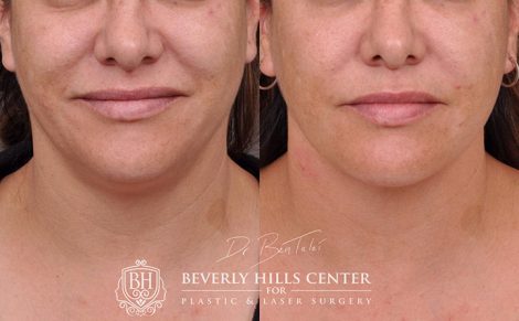 Mini Weekend Neck Lift - Front