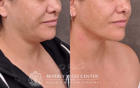 Mini Weekend Neck Lift - Right Side
