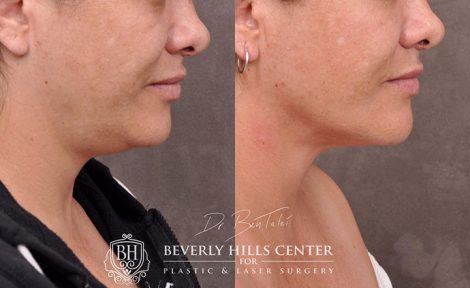 Mini Weekend Neck Lift - Right Side