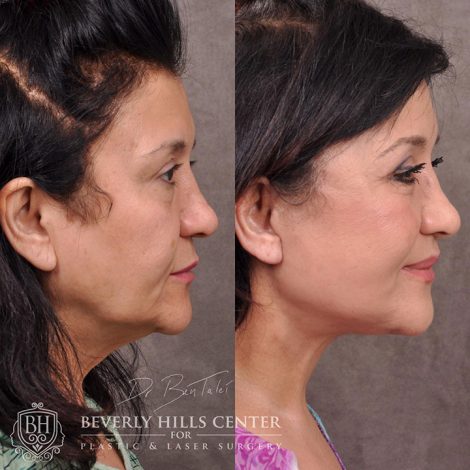 Beverly Hills Center Female Patient Before and After AuraLyft with upper and lower eyelid and lip lift