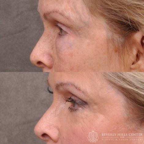 Lower Eyelid Correction after bad fat grafting