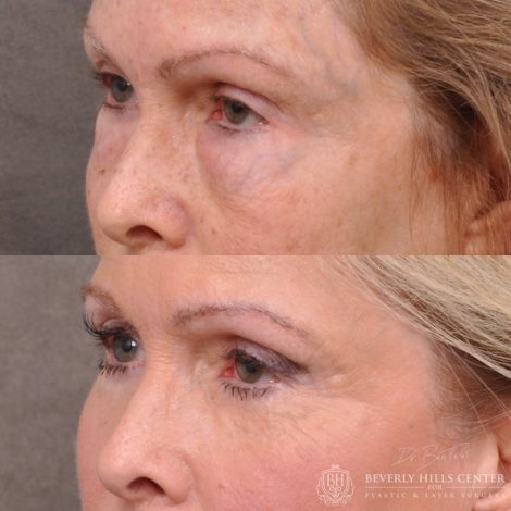 Lower Eyelid Correction after bad fat grafting