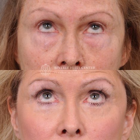 Lower Eyelid Correction after bad fat grafting