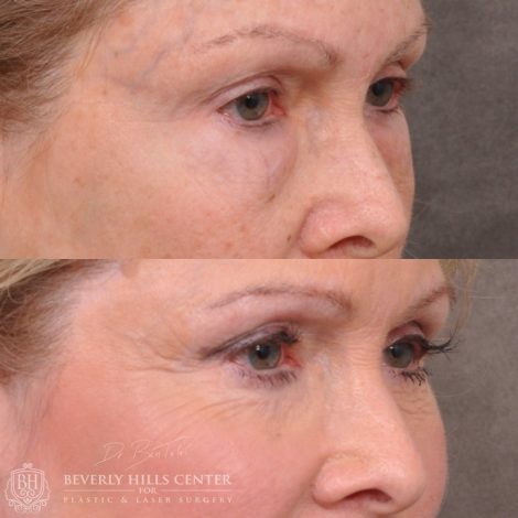 Lower Eyelid Correction after bad fat grafting