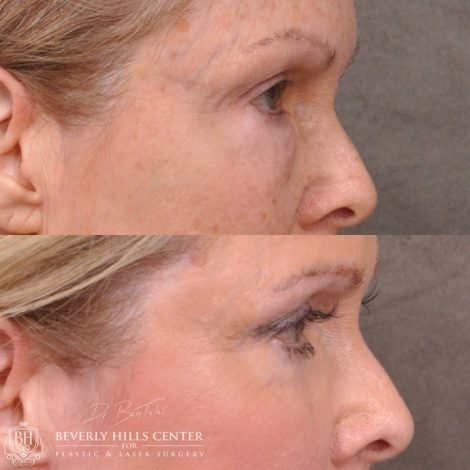 Lower Eyelid Correction after bad fat grafting