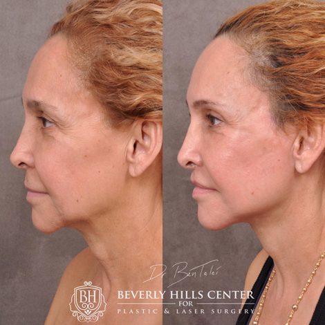 Auralyft, mini brow lift, lip lift, and Upper & Lower eyelids - Left Side