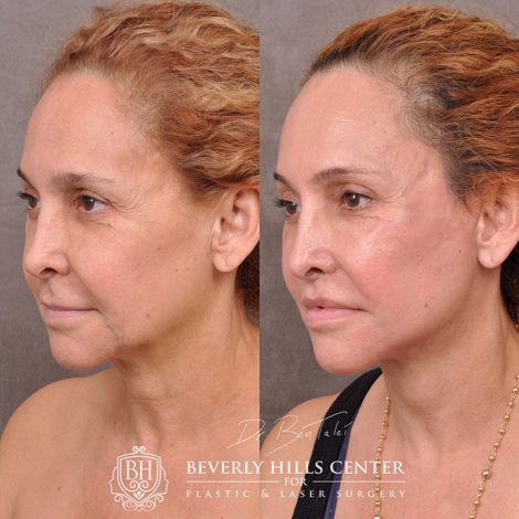 Auralyft, mini brow lift, lip lift, and Upper & Lower eyelids - Left Side