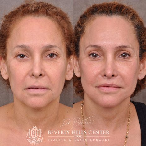 Auralyft, mini brow lift, lip lift, and Upper & Lower eyelids - Front
