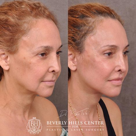 Auralyft, mini brow lift, lip lift, and Upper & Lower eyelids - Right Side