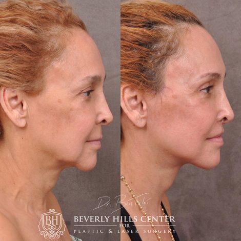 Auralyft, mini brow lift, lip lift, and Upper & Lower eyelids - Right Side