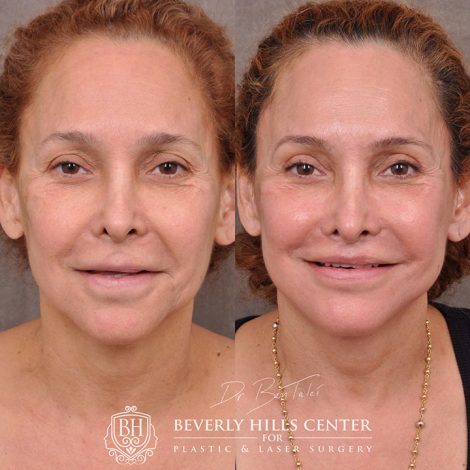 Auralyft, mini brow lift, lip lift, and Upper & Lower eyelids - Front